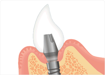 移植インプラント