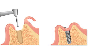 インプラント治療の流れ1