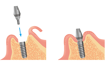 インプラント治療の流れ2