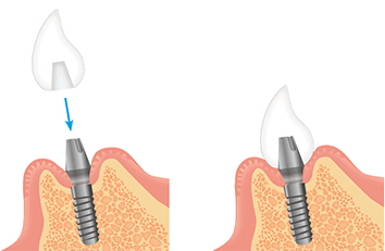 インプラント治療の流れ3